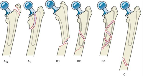 THA Periprosthetic Fracture Recon Orthobullets
